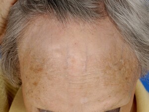 frontal-fibrosing-alopecia-1