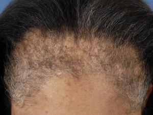 frontal-fibrosing-alopecia-4